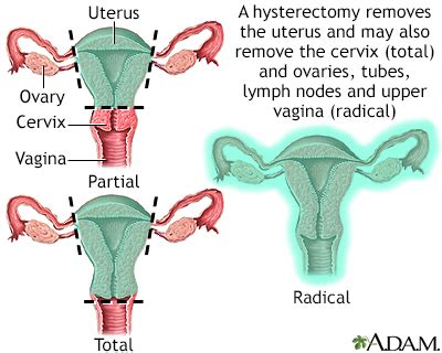 nursing diagnosis of hysterectomy|Vaginal Hysterectomy .